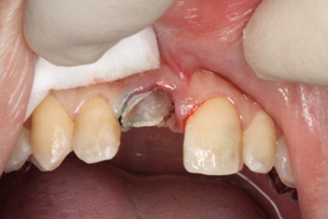 前歯のレジン治療