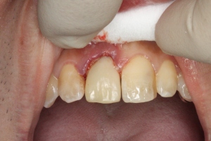 前歯のレジン治療後